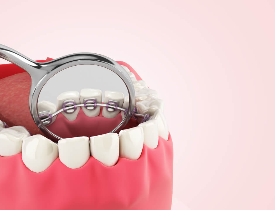 What are lingual braces?