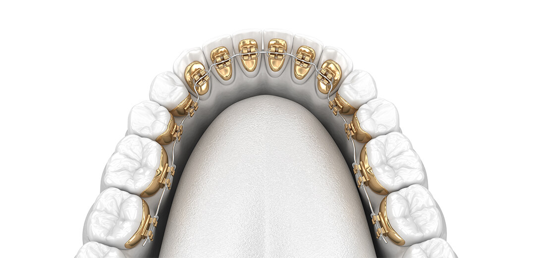 The Pros and Cons of Lingual Braces