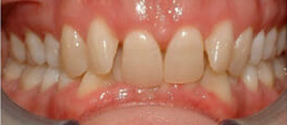 Teath Before Teath Before