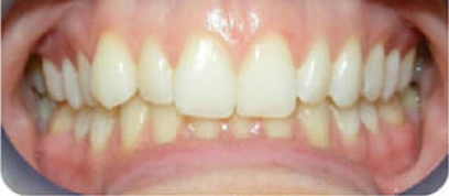 Teath Before Teath Before